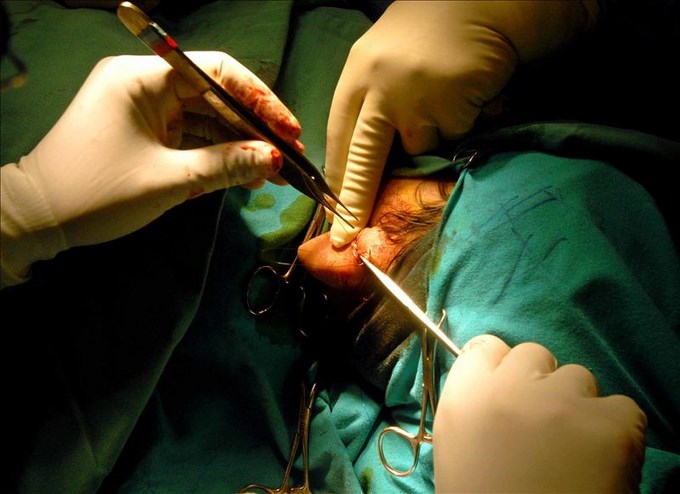 celulas madre labio leporino