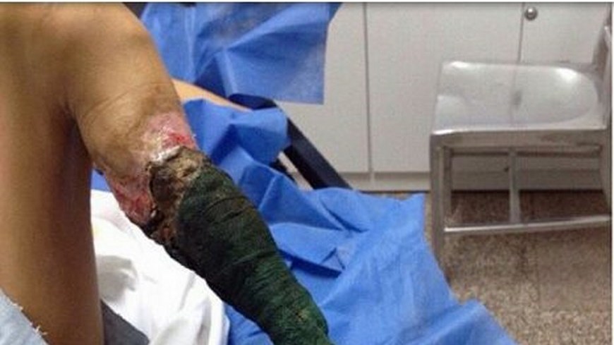 Así quedó la pierna de una joven tras la mordedura de una serpiente 1 pierna joven Copiar