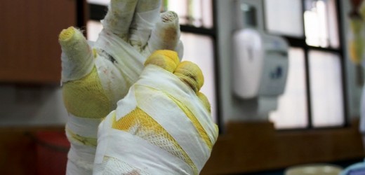 4 lesionados por pólvora en el resto de Antioquia