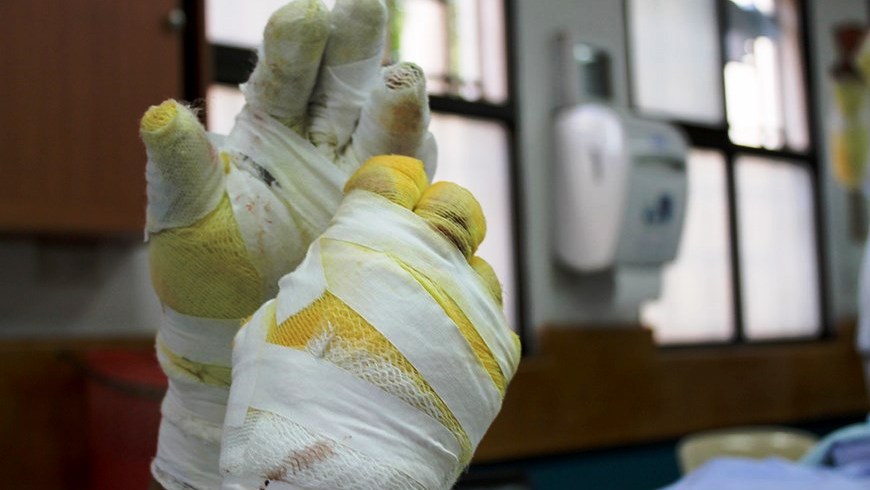 Le amputaron los dedos de la mano a un hombre en Medellín quien se lesionó manipulando pólvora Le amputaron los dedos de la mano a un hombre en Medellín quien se lesionó manipulando pólvora