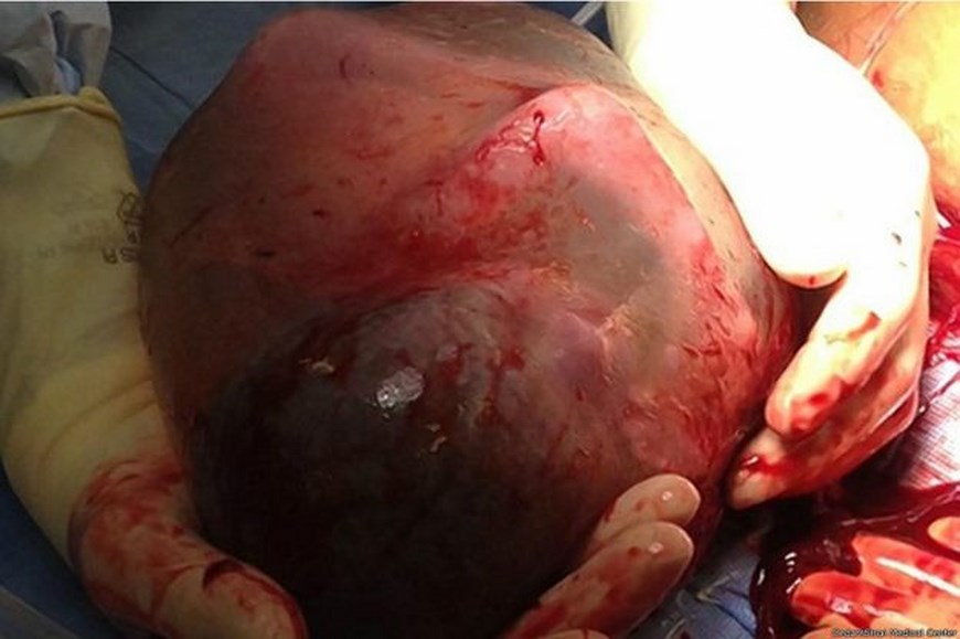 bebe nace saco amniotico