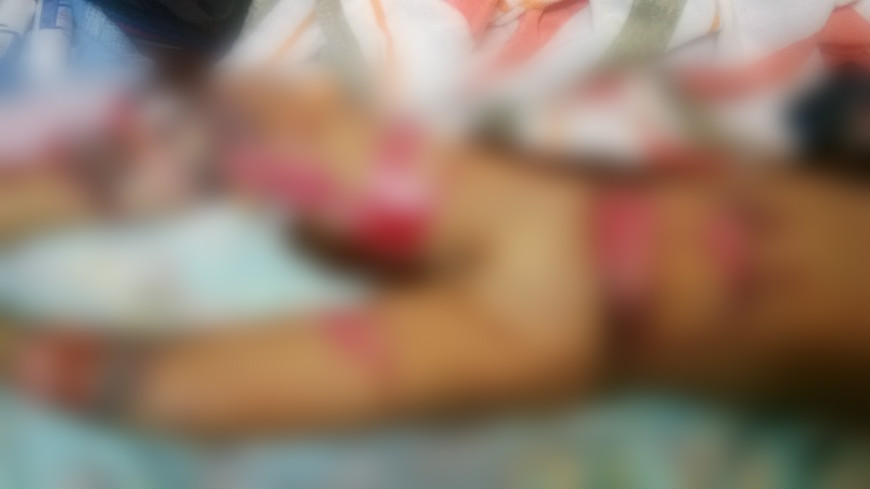 QUEMADURAS DE MAURICIO