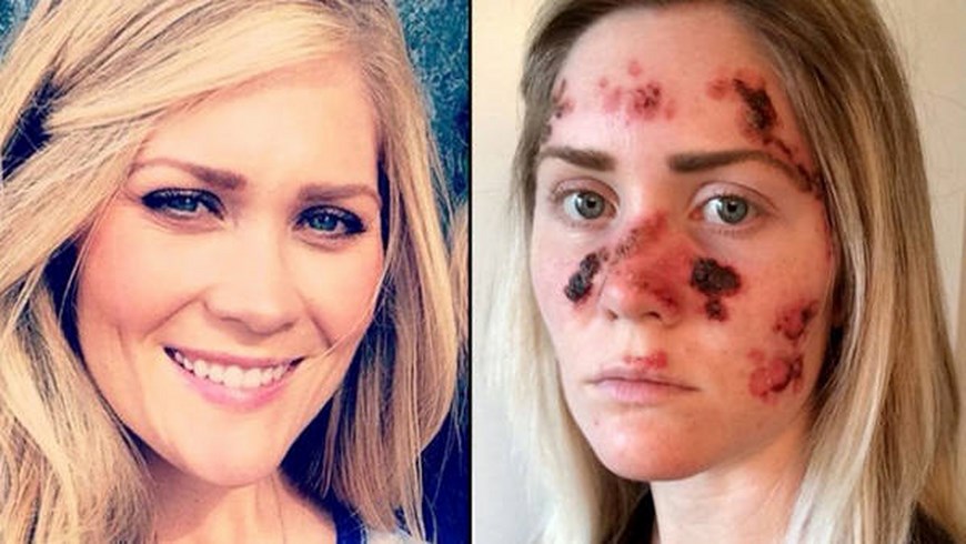 Tawny-Willoughby-cancer-alertar-solar_CLAIMA20150513_0065_28 (Copiar)