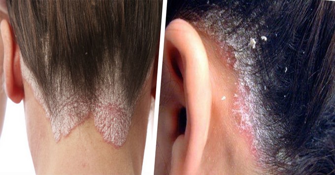 Hongos en el cuero cabelludo/ Tomada de Internet