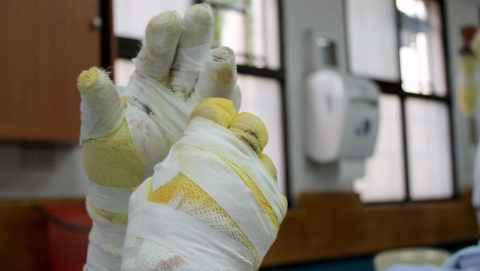 quemaduras, quemados