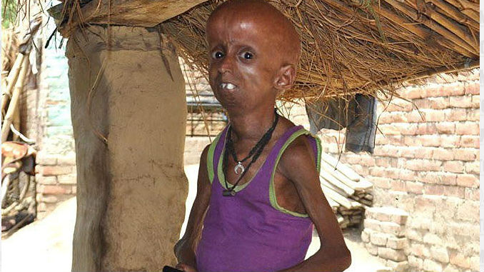 Rupesh_Progeria_2