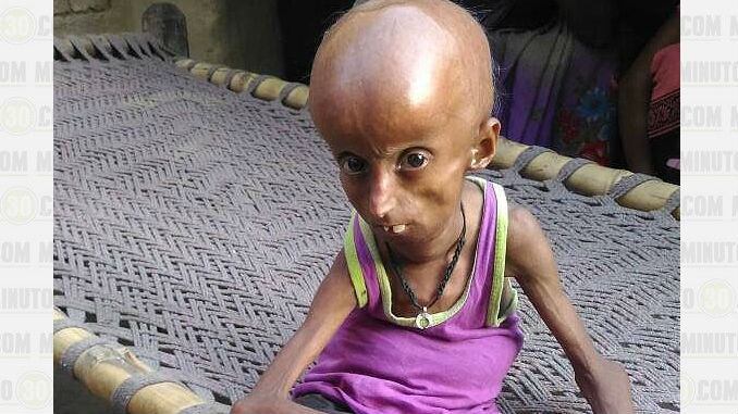 Rupesh_Progeria_3