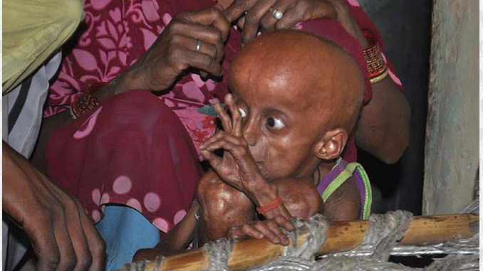 Rupesh_Progeria_4
