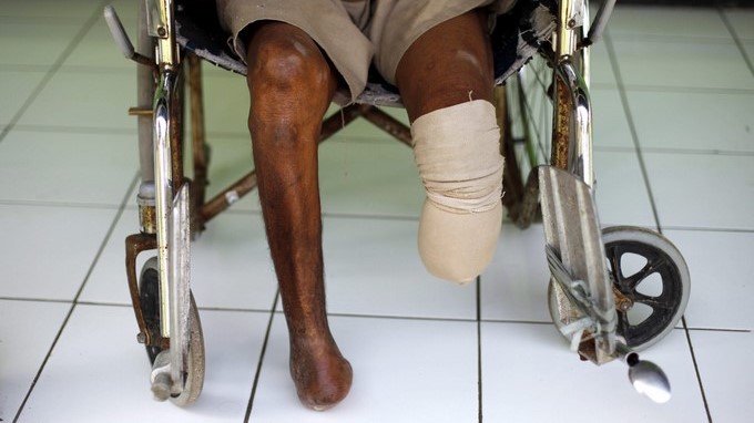 En la imagen, un paciente afectado de lepra con amputaciones. EFE/Archivo