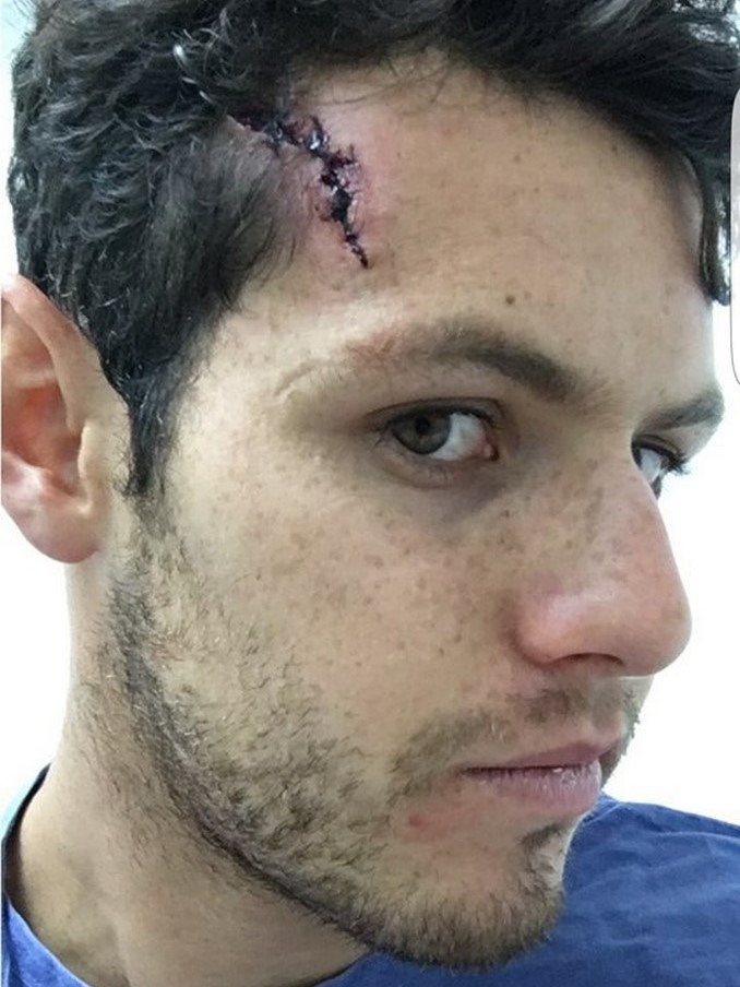 ¡Qué golpe! Así le quedó el rostro al defensor de Millonarios, Pedro Franco 3 pedro franco 1