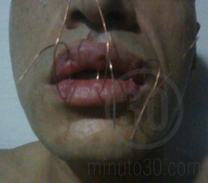 Interno de la cárcel Bellavista se habría 'cosido' la boca porque no le han entregado el brazalete electrónico