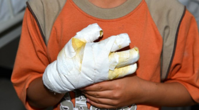 Niño, menor, quemado con pólvora