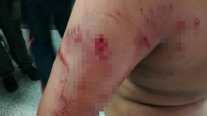 Un perro de raza potencialmente peligrosa atacó a un niño en Villa Hermosa 5 ni%C3%B1o atacado