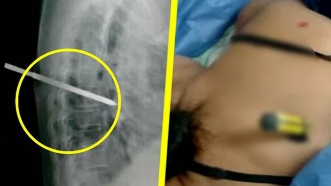 Su esposo la hirió con un destornillador porque ella decidió terminar con la relación