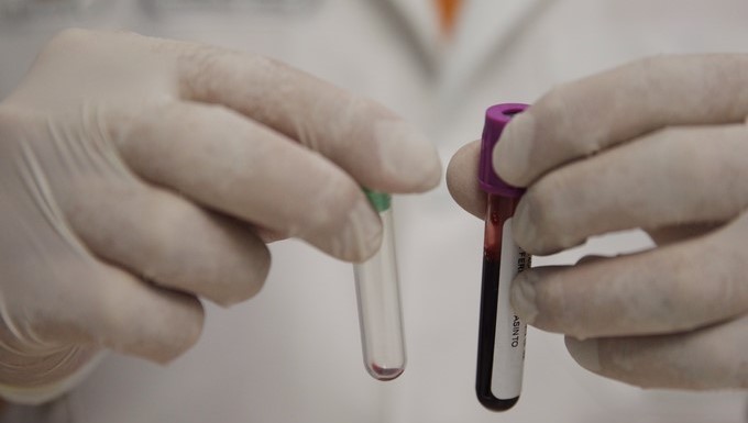 El 90 % de pacientes con leucemia mieloide aguda mueren antes del tratamiento 2 MUESTRA LABORATORIO CIENTIFICOS SALUD Copiar
