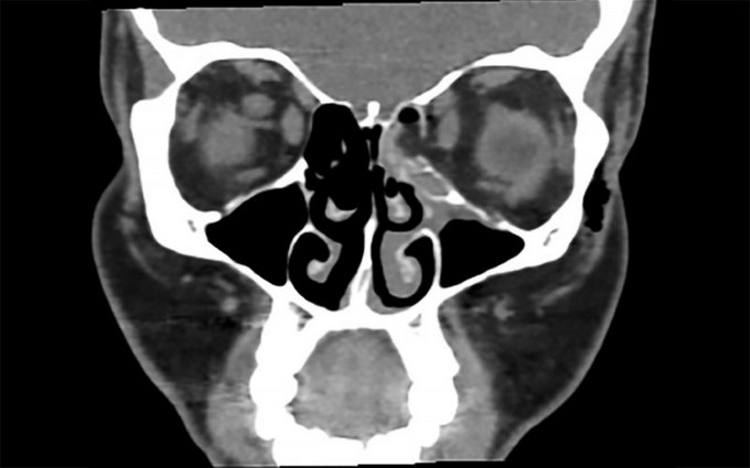 Image: Fractura después de sonarse (BMJ Case Reports 2018)