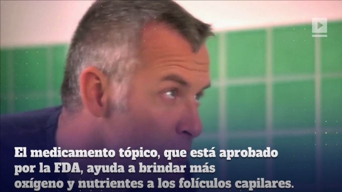 calvicie