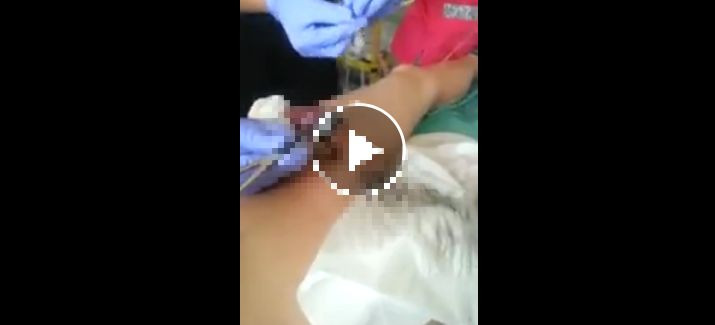 Vídeo. La dolorosa práctica que se hizo en el pene casi se lo echa a perder