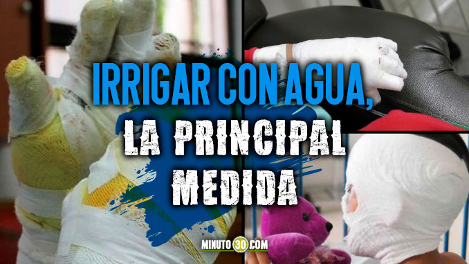 Quemaduras con pólvora o líquidos calientes, frecuentes en Navidad. Las recomendaciones para tratar las lesiones