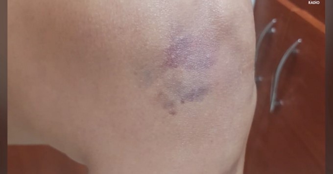 Revelan fotos de cómo quedó el cuerpo de la teniente que habría sido abusada por un capitán de la Policía 5 foto 4