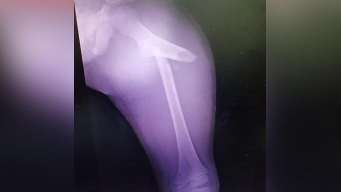 Judicializan a hombre que de una patada le habría fracturado la pierna a su hijo de 5 años en Barranquilla