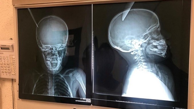 Mientras jugaban un menor de 7 años le clavó un cuchillo en la cabeza a otro niño de 5