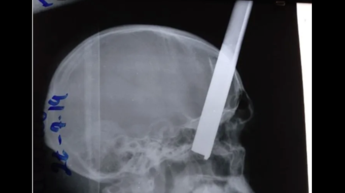 Fotos: dos ‘amigos’ trabajaban y bebían, pero terminaron peleando y uno le atravesó la cabeza al otro con una varilla de hierro