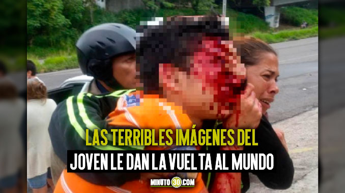 EN FOTOS Y VIDEO: Policía venezolana dejó ciego y desfiguró a un adolescente de 16 años al disparar perdigones en la cara