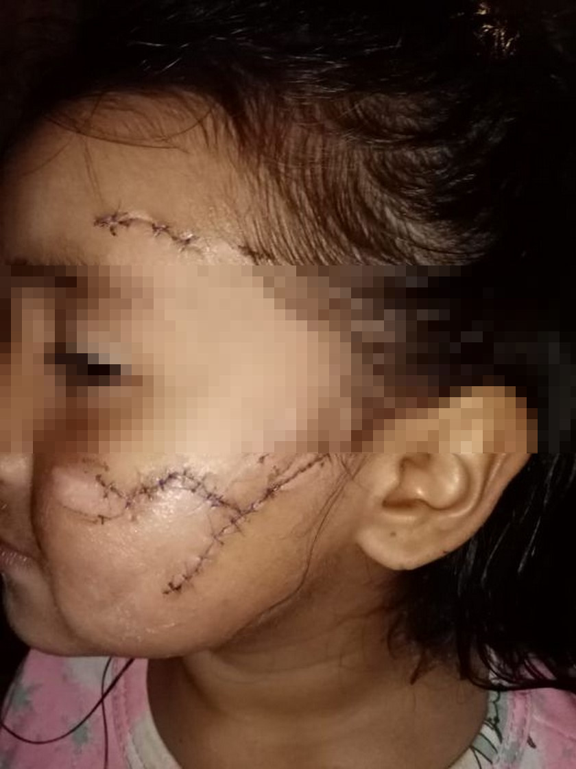 Fotos: Un perro atacó a una niña de tres años en Bogotá, provocándole graves heridas en su rostro 2 18 11 19 nina atacada pitbul bogota
