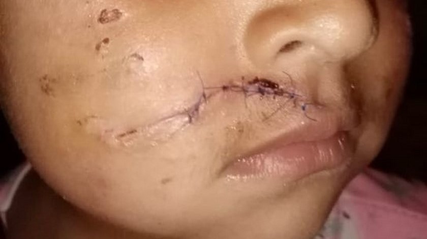 Fotos: Un perro atacó a una niña de tres años en Bogotá, provocándole graves heridas en su rostro 1 18 11 19 nina atacada pitbul bogota1 1