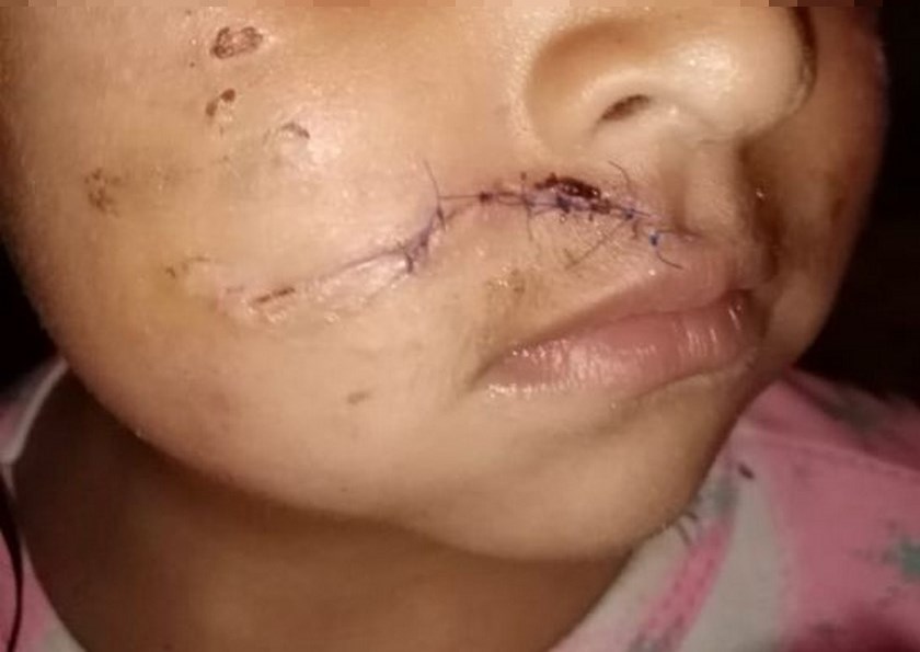 Fotos: Un perro atacó a una niña de tres años en Bogotá, provocándole graves heridas en su rostro 3 18 11 19 nina atacada pitbul bogota1