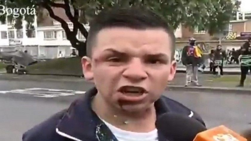 “Salí de estudiar y vea lo que me hicieron”, estudiante relató que le dieron con una bala de goma durante el paro