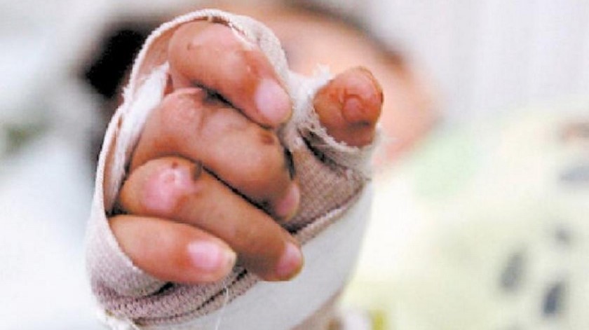 Quemados ilustrativa