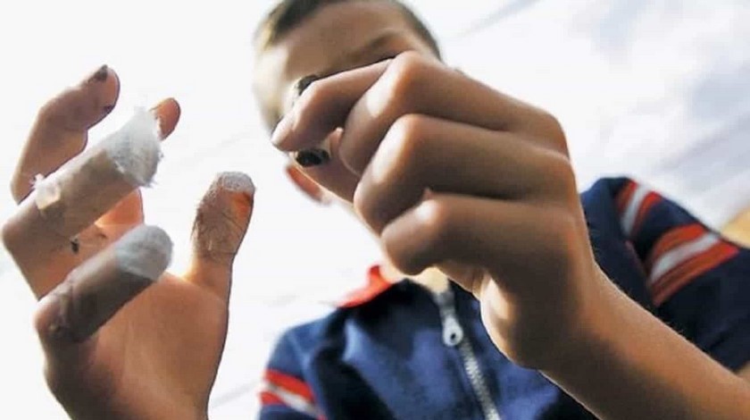 Menor de 17 años resultó lesionado con una ‘papeleta’ en Gómez Plata, ya van 30 quemados por pólvora en Antioquia