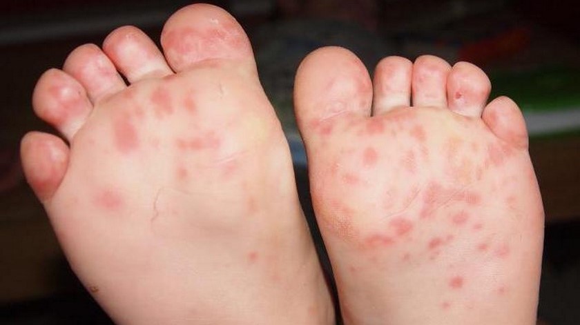 Confirman enfermedad de Kawasaki en un niño de la ciudad de Bogotá: no es el primer caso en Colombia