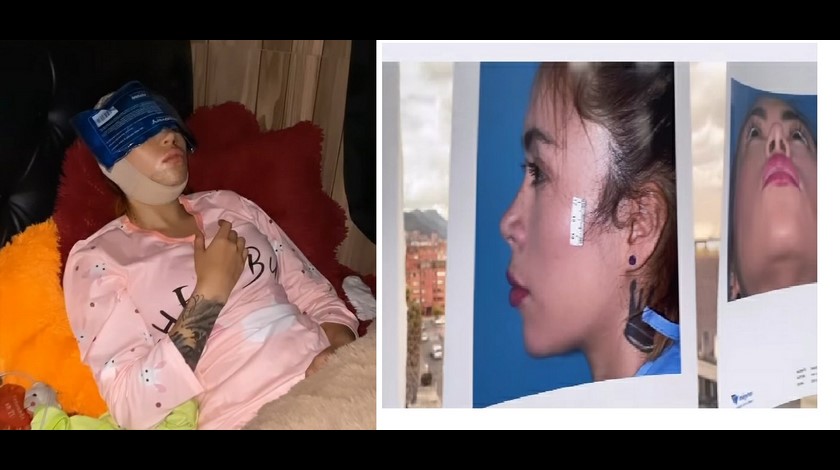 Epa Colombia: nueva nariz porque “parecía una arepa”