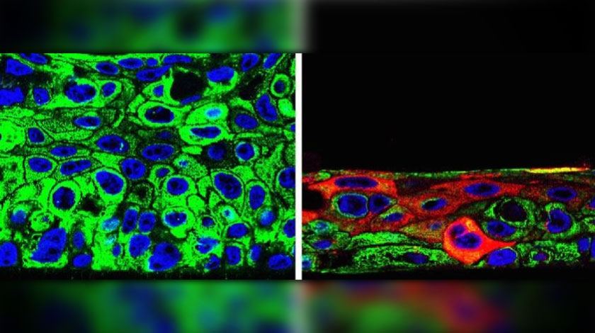 Identifican moléculas clave para la malignidad del cáncer de cabeza y cuello