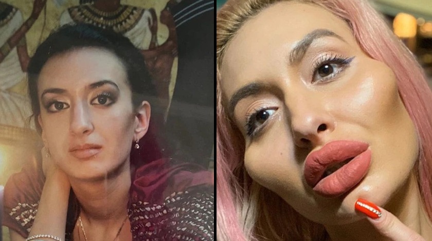 FOTOS: ¿Valió la pena? Así ha sido el impresionante cambio de la mujer con las mejillas más grandes del mundo