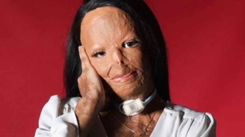 FOTOS: Con 16 años se siente perfecta, Aleema utilizó un champú antipiojos que le destrozó la cara