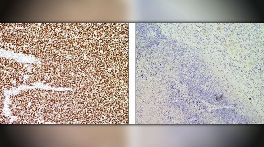 Utilizan CRISPR para eliminar células tumorales sin tocar las sanas