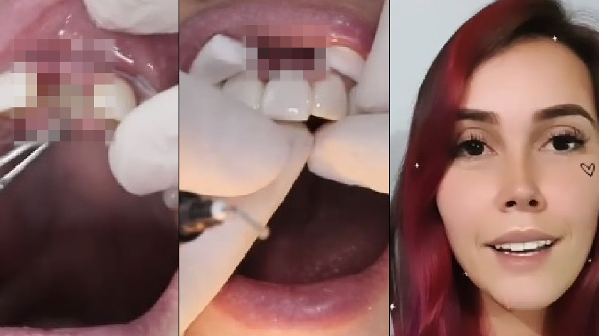 Diente provisional de Manuela Gómez