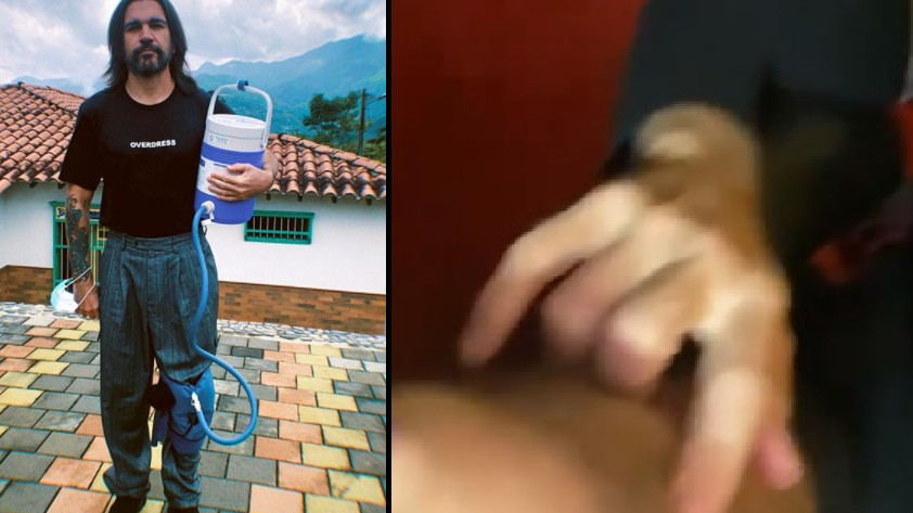 VIDEO: ¡Mostró la cirugía! Juanes sufrió una lesión entrenando y por eso lo operaron de la rodilla