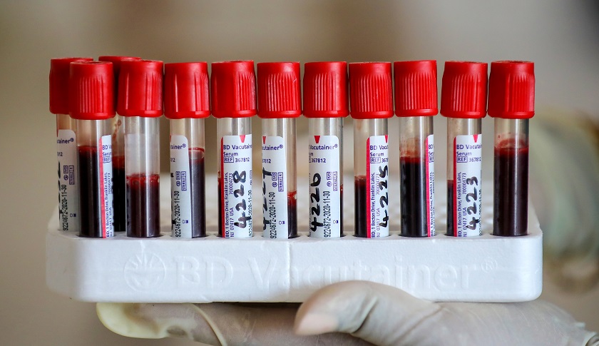 Una prueba de sangre podría predecir el desarrollo de alzhéimer