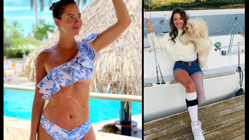 VIDEO: “Mi pie derecho no volverá a funcionar”: Daniella Álvarez contó lo que le dijeron los médicos