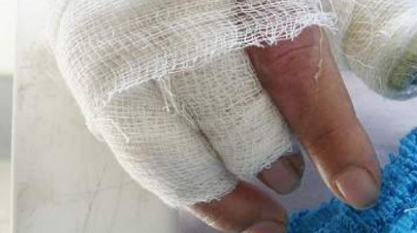 VIDEO: Por un volador, mujer de 22 años: nueva quemada con pólvora en La Estrella 1 quemada polvora mujer
