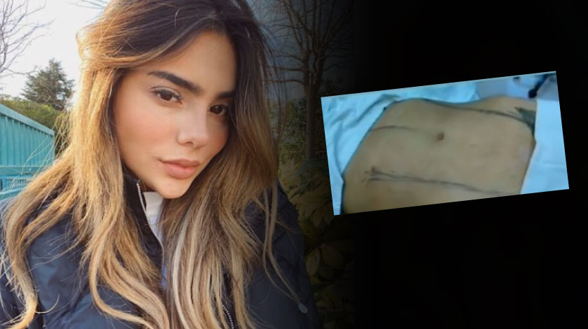 VIDEO: ¡Para quedar como una Barbie!, dejaron ver el antes y después de la lipomarcación que se hizo la hermana de James Rodríguez 5 juana 1