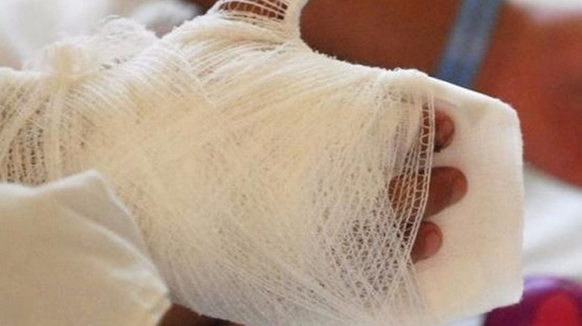 VIDEO: Menor de 16 años resultó quemado con pólvora en Marinilla, manipulaba una papeleta 1 quemado