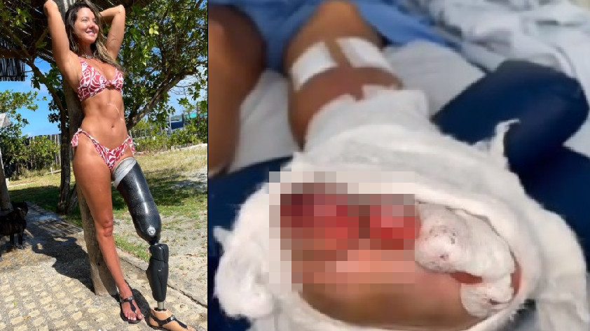 VIDEOS: ¡Muy valiente! Daniella Álvarez reveló impactantes imágenes de la isquemia en su pierna antes de la amputación