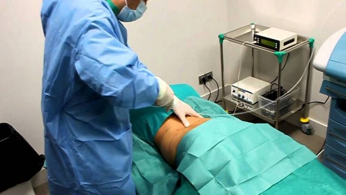 ¡Lamentable! Mujer de 42 años murió en una clínica de Cali tras someterse a una ‘sutil’ lipoescultura