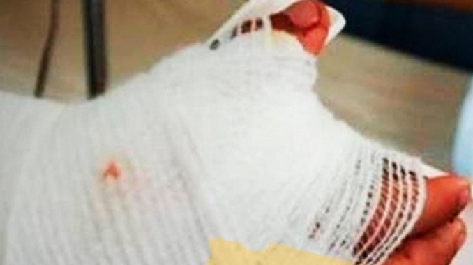 Dos hombres se quemaron en Robledo y Santa Elena por manipular ‘voladores’, ya van 23 lesionados